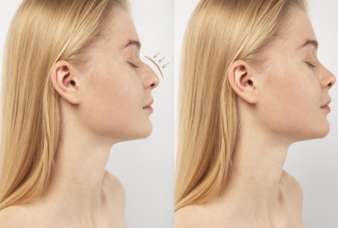 Rhinoplasty (Nose Job) in turkey